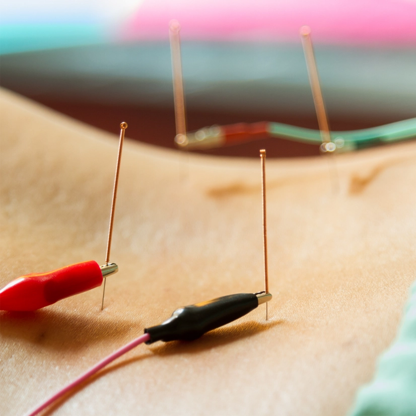 Contemporary Medical Acupuncture Barrie