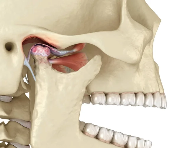 Understanding TMJ Dysfunction Jaw Skull